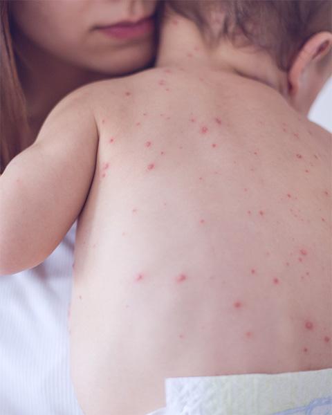 Health Department Measles Picture